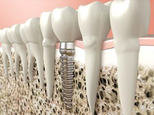 Restorative Dental Care